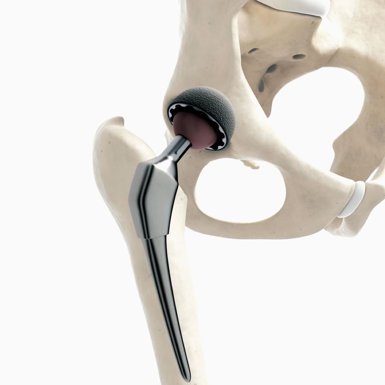 Современные эндопротезы Современные эндопротезы